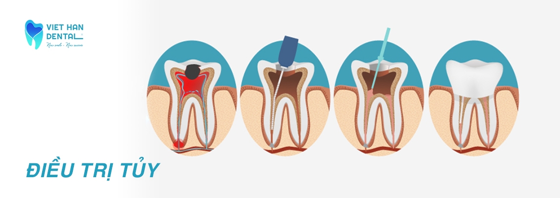 Điều Trị Tủy Răng