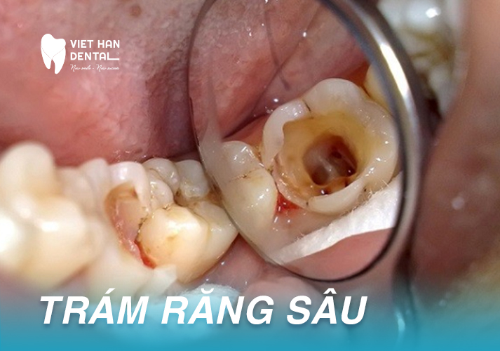 Trám Răng Bị Sâu