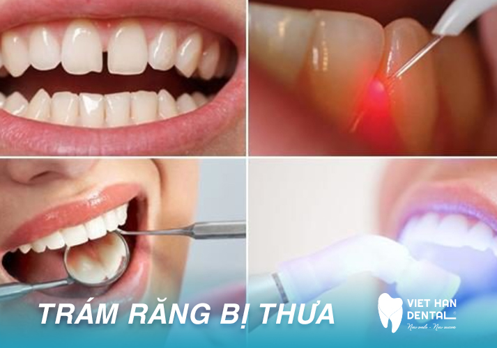 Trám Răng Bị Thưa