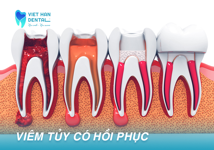 Viêm Tủy Có Hồi Phục
