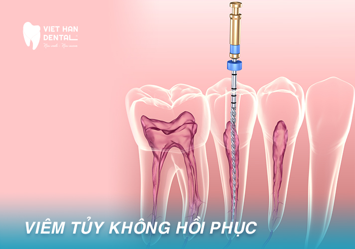 Viêm Tủy Không Hồi Phục