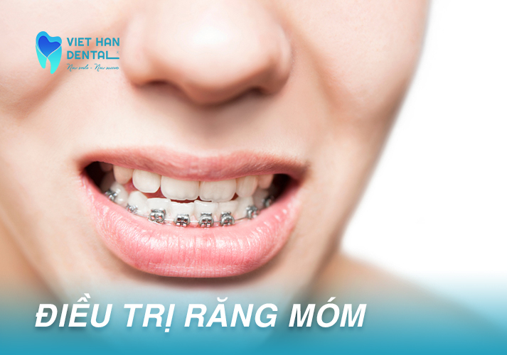 Một trường hợp răng bị móm 