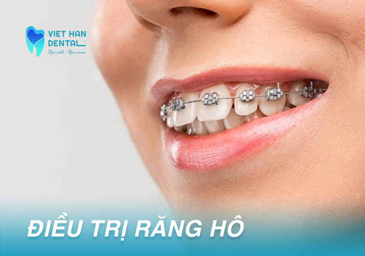 Một trường hợp điều trị răng hô bằng niềng răng mắc cài