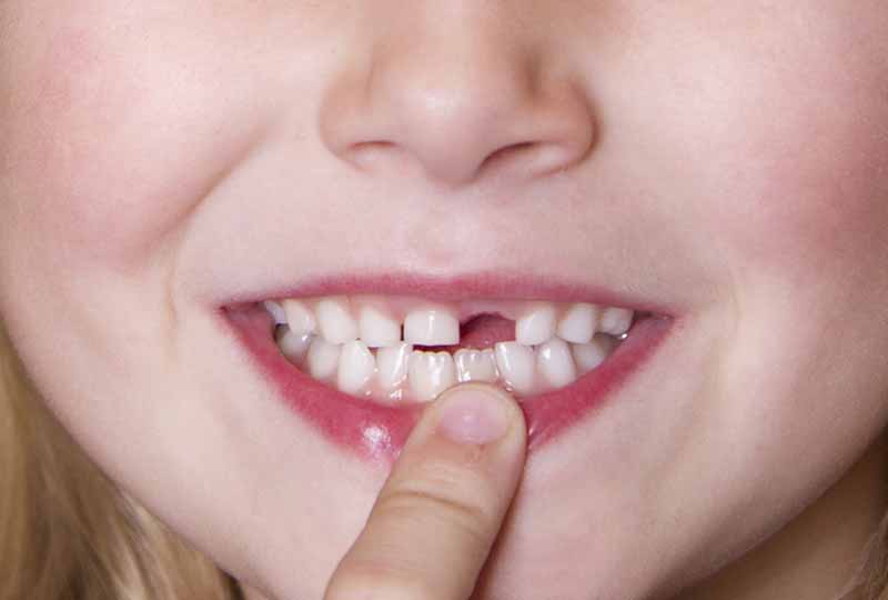 Răng sữa của trẻ
