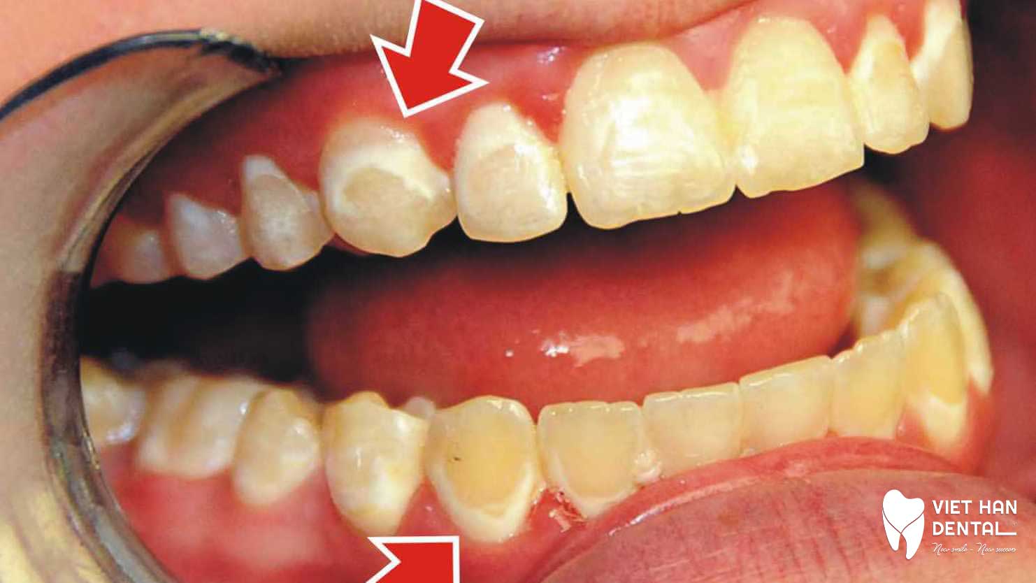 Tình trạng thiểu sản men răng 