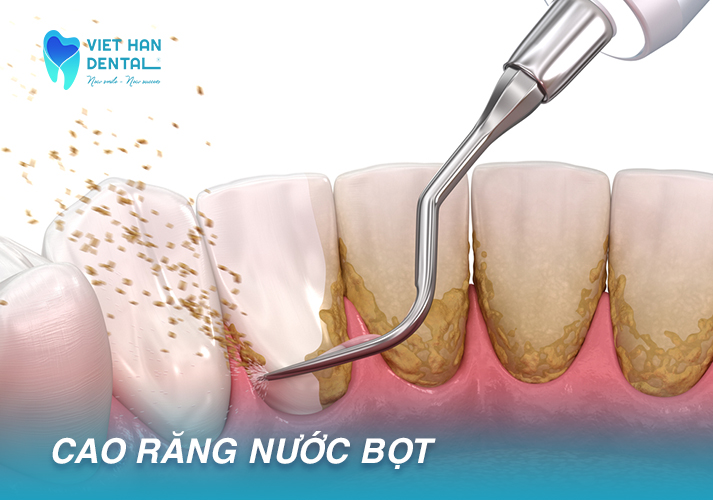 Cao răng nước bọt 