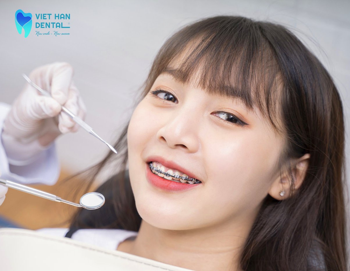 Một bạn tuổi teen đang niềng răng