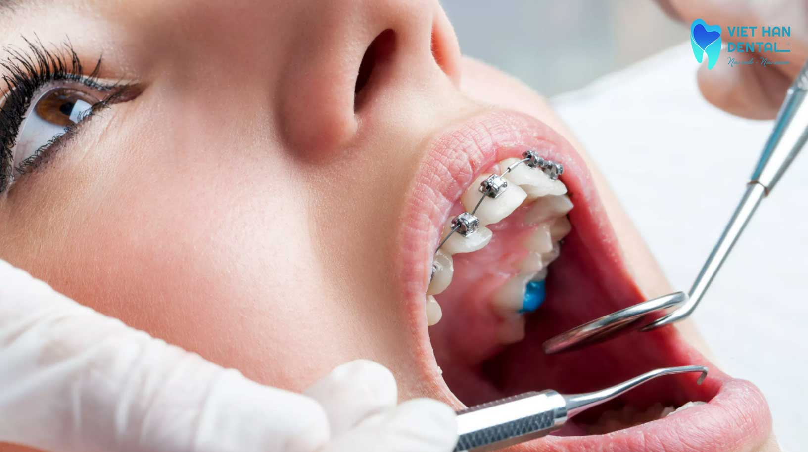 Cố gắn mắc cài kim loại trên răng cho người đang mang thai