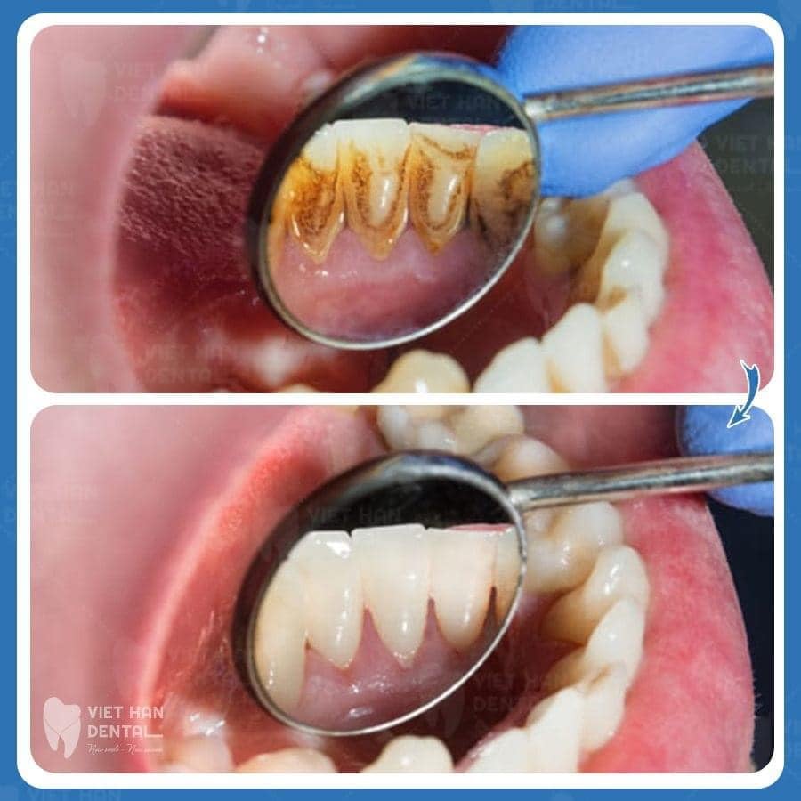 Mảng bám, cao răng và sâu răng