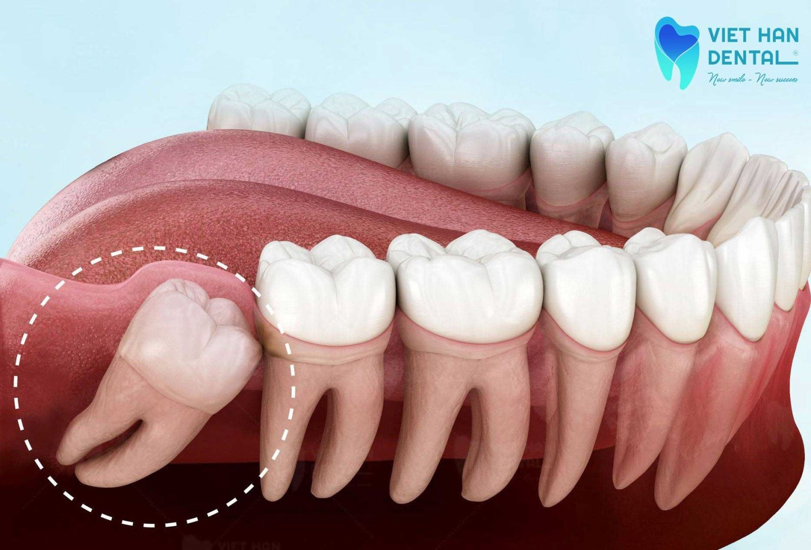 Răng khôn là chiếc răng vĩnh viên cuối cùng mọc trong miệng 