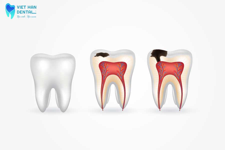 Tiến trình sâu răng điển hình