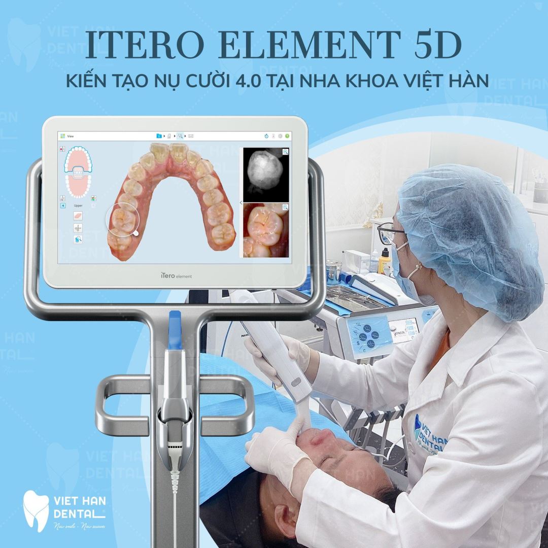 quét dấu răng với công nghệ iTero