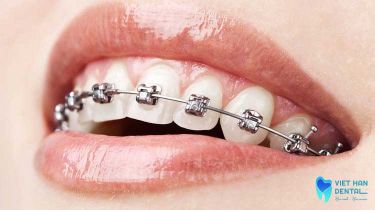 niềng răng mắc cài tự buộc
