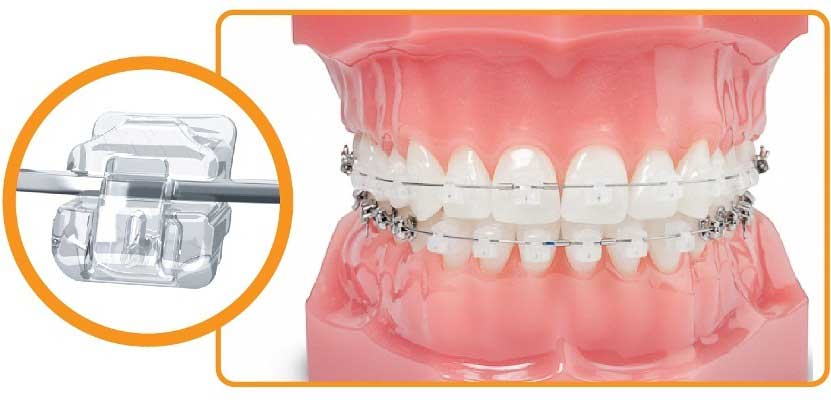 mắc cài sứ tự động