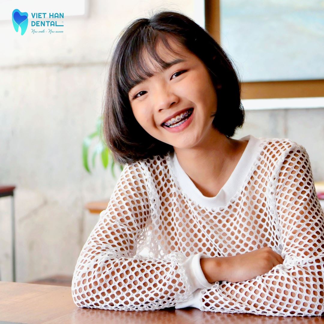 Niềng răng khổng nhổ răng không được áp dụng với trẻ em ở độ tuổi đang phát triển
