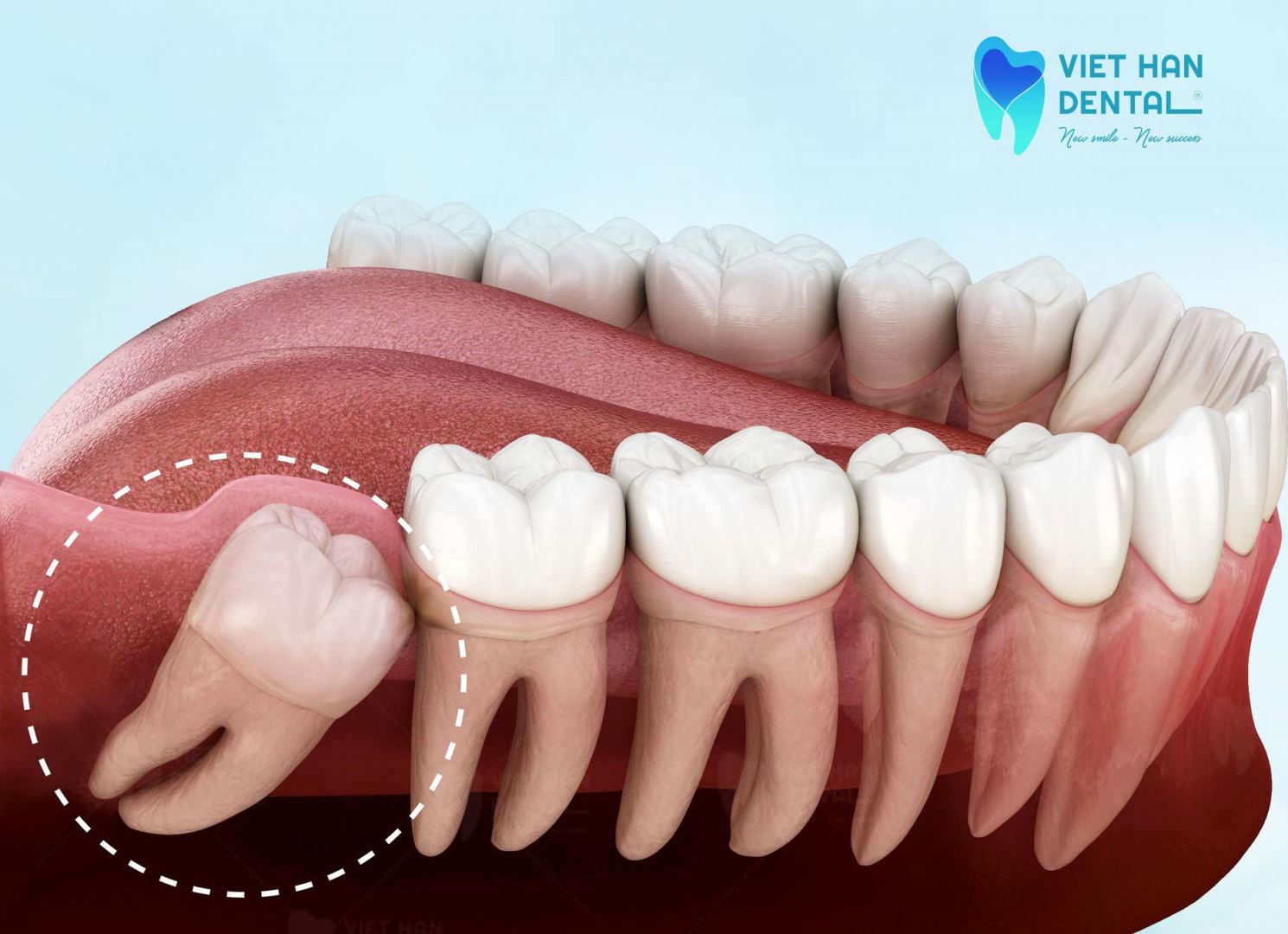 Răng sô 8 được chỉ định nhổ trường hợp niềng cần nhổ răng