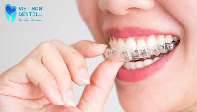 Niềng răng Invisalign - giải pháp tuyệt vời cho mọi tình huống 