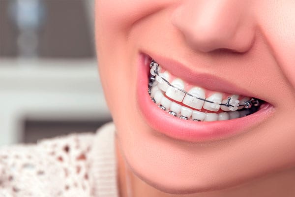 Mắc cài sứ, pha lê