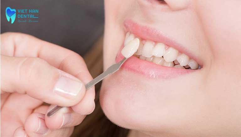 Thực hiện dán mặt sứ veneer vào răng của khách hàng
