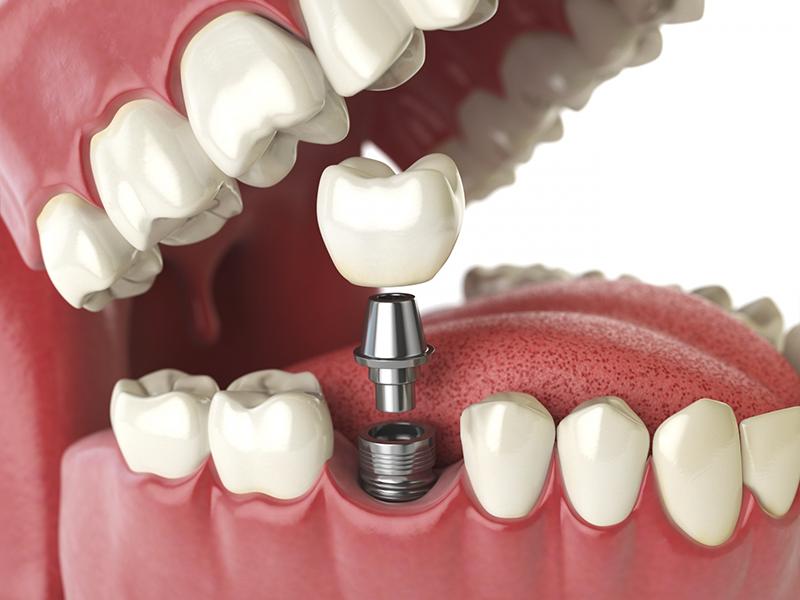 trồng răng implant