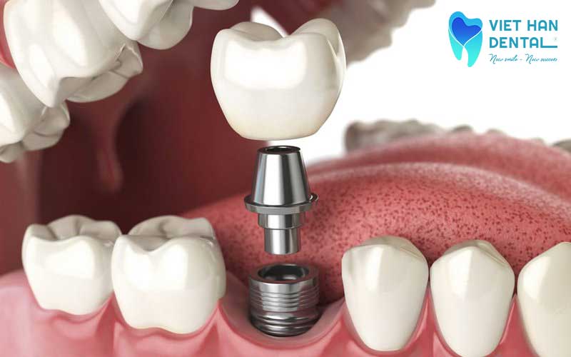 Trồng răng Implant