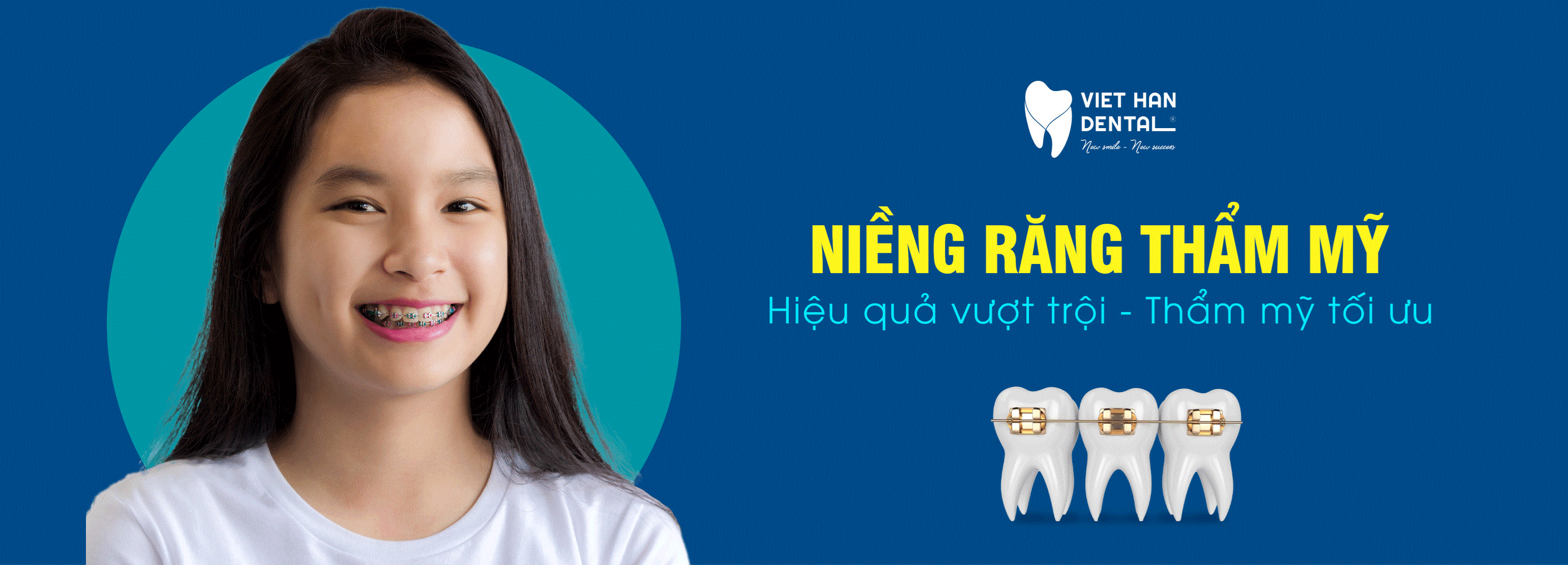 Niềng răng