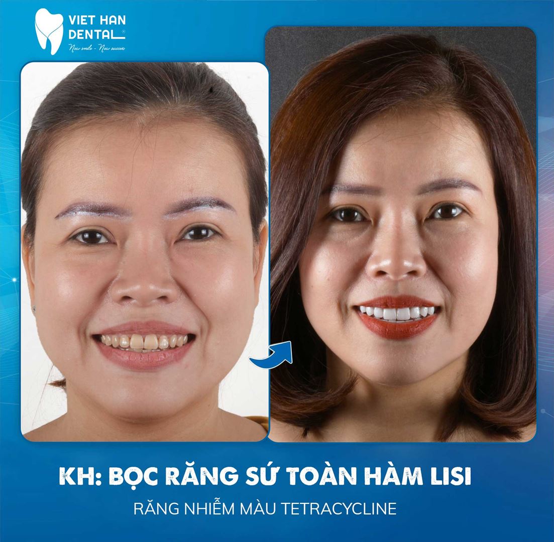 Phục hình răng sứ thẩm mỹ